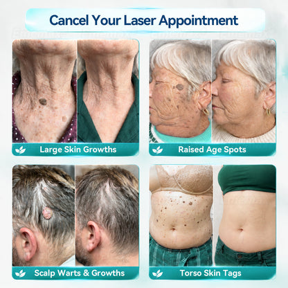 𝐄𝐦𝐞𝐦𝐚𝐱®𝟐-𝐢𝐧-𝟏 𝐌𝐢𝐜𝐫𝐨𝐧𝐞𝐞𝐝𝐥𝐞 & 𝐇𝐲𝐝𝐫𝐨𝐜𝐨𝐥𝐥𝐨𝐢𝐝 𝐌𝐨𝐥𝐞 𝐑𝐞𝐦𝐨𝐯𝐚𝐥 𝐏𝐚𝐭𝐜𝐡(Zero Pain, Zero 𝐒𝐜𝐚𝒓𝒔 patch)💪
