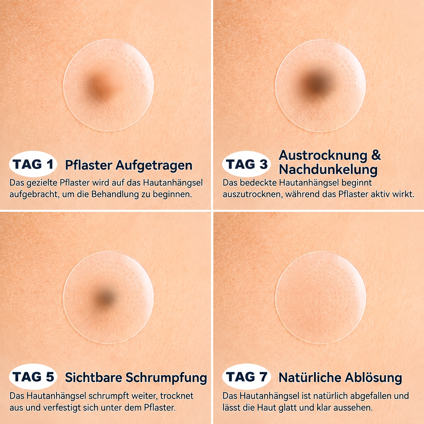 𝐄𝐦𝐞𝐦𝐚𝐱®𝟐-𝐢𝐧-𝟏 𝐌𝐢𝐜𝐫𝐨𝐧𝐞𝐞𝐝𝐥𝐞 & 𝐇𝐲𝐝𝐫𝐨𝐜𝐨𝐥𝐥𝐨𝐢𝐝 𝐌𝐨𝐥𝐞 𝐑𝐞𝐦𝐨𝐯𝐚𝐥 𝐏𝐚𝐭𝐜𝐡(Zero Pain, Zero 𝐒𝐜𝐚𝒓𝒔 patch)💪