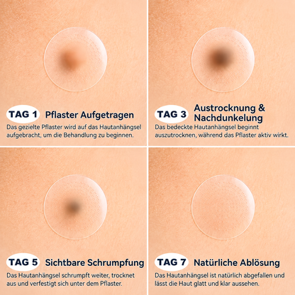 𝐄𝐦𝐞𝐦𝐚𝐱®𝟐-𝐢𝐧-𝟏 𝐌𝐢𝐜𝐫𝐨𝐧𝐞𝐞𝐝𝐥𝐞 & 𝐇𝐲𝐝𝐫𝐨𝐜𝐨𝐥𝐥𝐨𝐢𝐝 𝐌𝐨𝐥𝐞 𝐑𝐞𝐦𝐨𝐯𝐚𝐥 𝐏𝐚𝐭𝐜𝐡(Zero Pain, Zero 𝐒𝐜𝐚𝒓𝒔 patch)💪